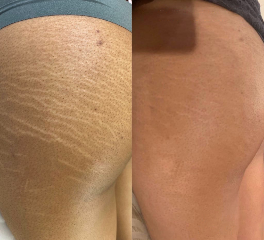 Cloverderm houston texas stretch marks and scars removal