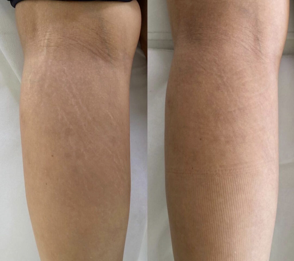 Cloverderm houston texas stretch marks and scars removalPicture